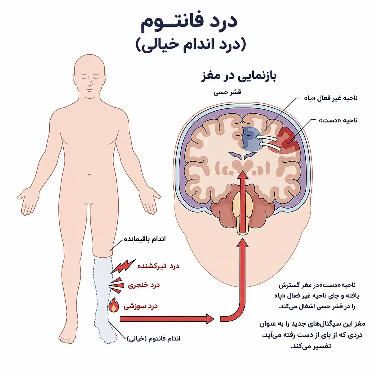 درد اندام خیالی