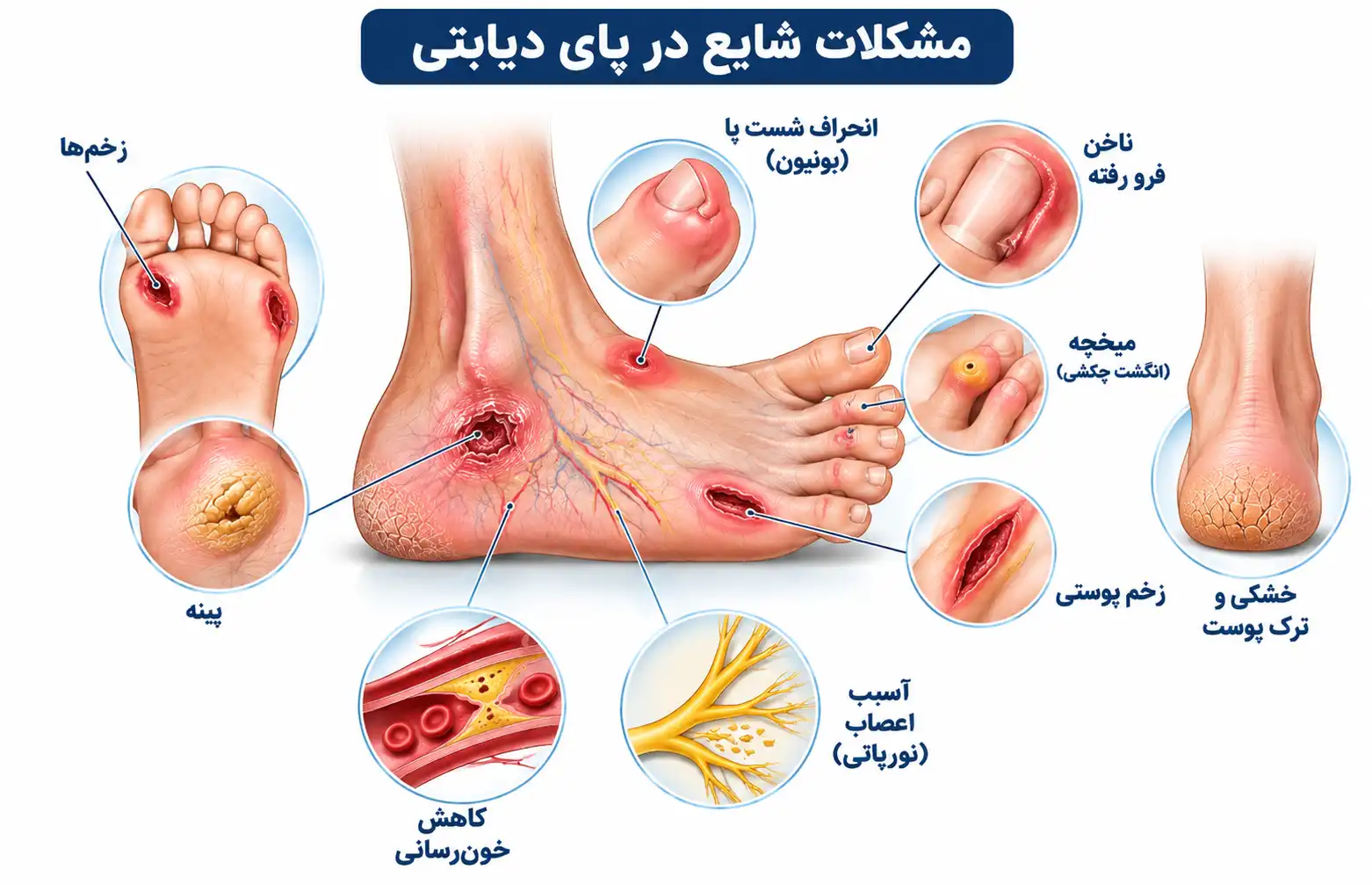 عوارض زخم پای دیابتی