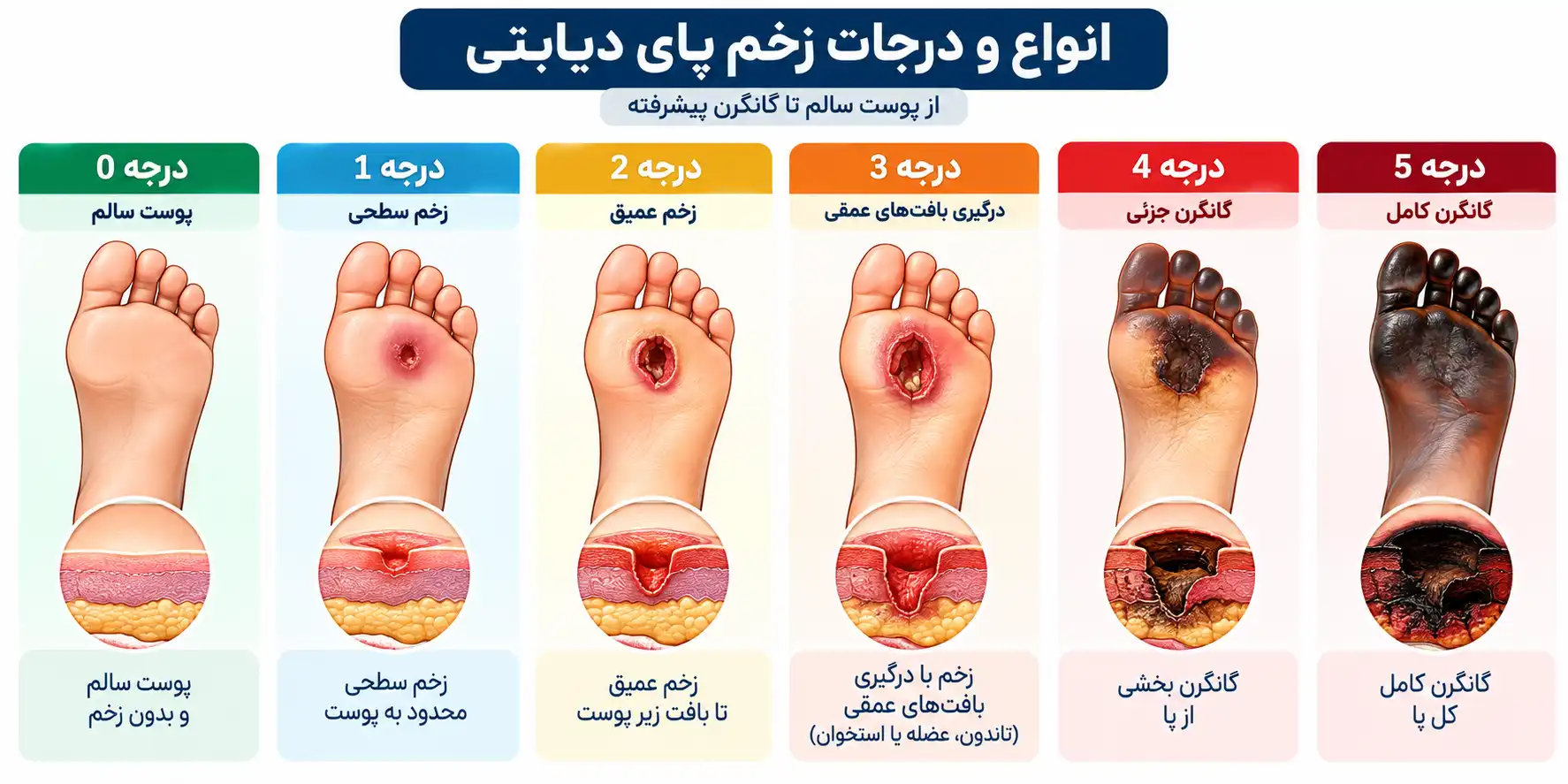 انواع زخم پای دیابتی