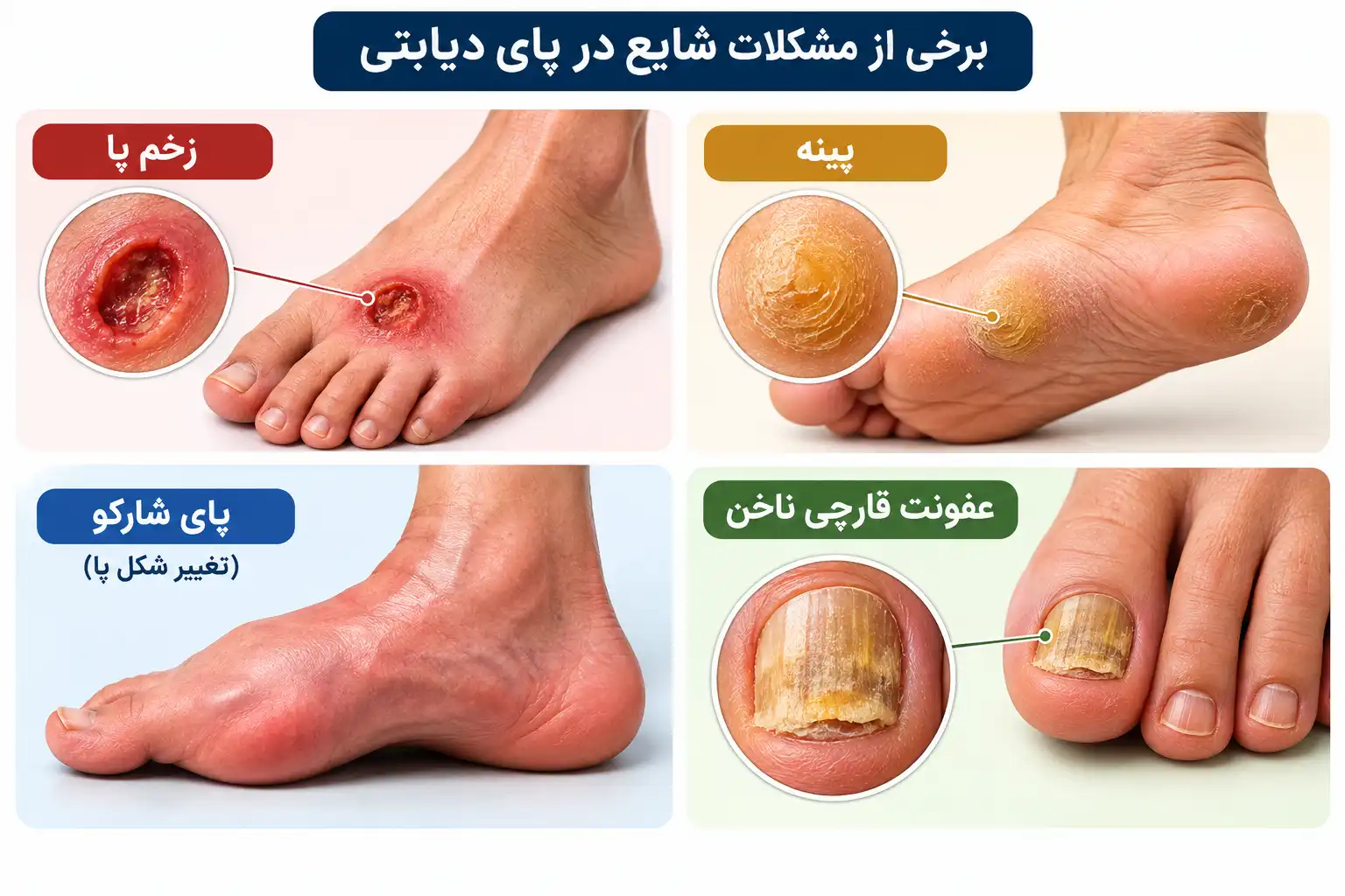 علائم زخم پای دیابتی چیست؟
